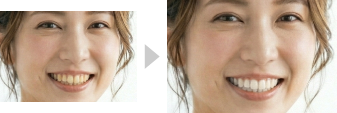 歯のホワイトニング